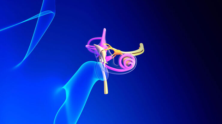 [Translate to chinese:] Superior Semicircular Canal Dehiscence (SSCD) or Minor’s syndrome.