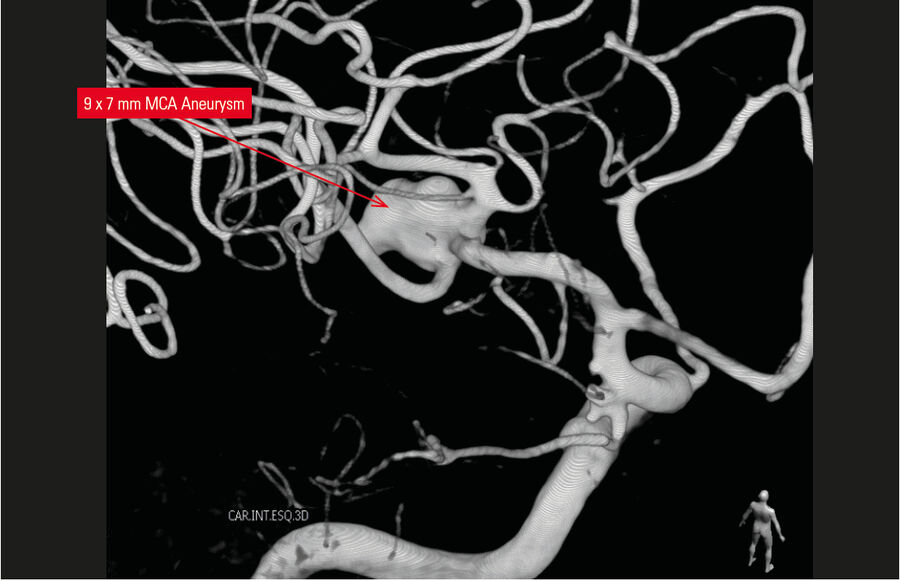 3D重构显示了MCA动脉瘤。
