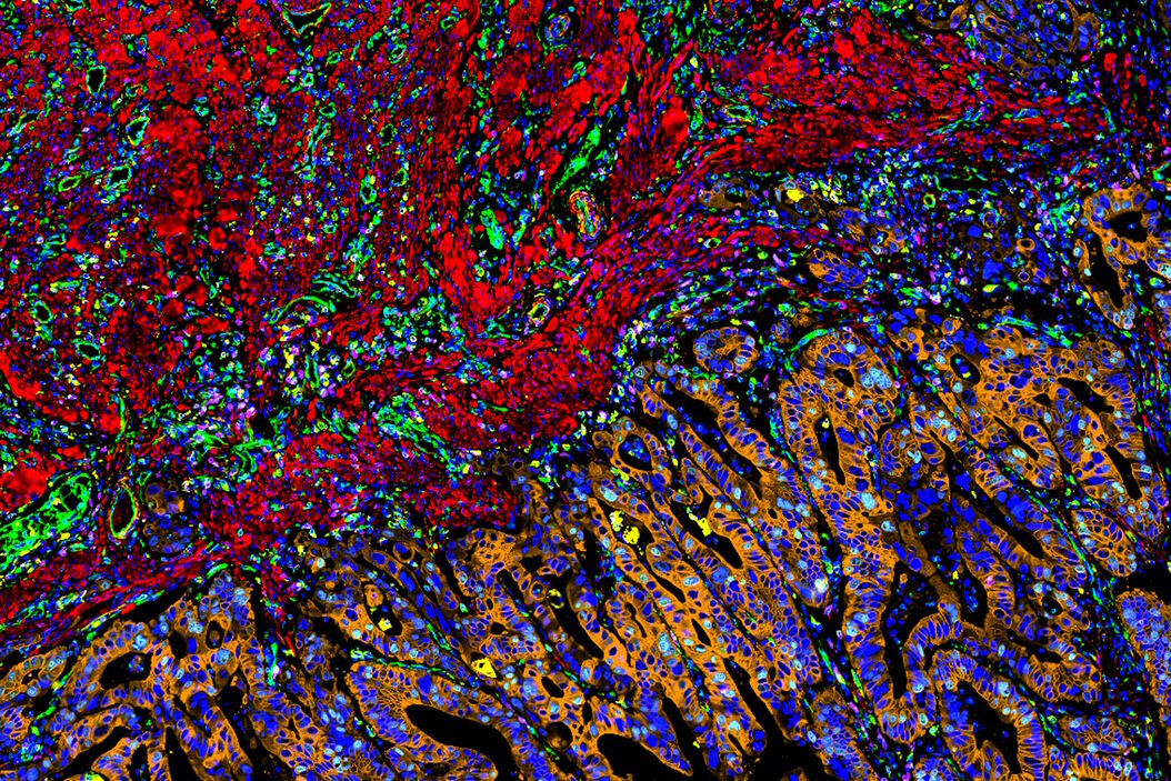  Human_colon_adenocarcinoma_CAC_tissue.jpg