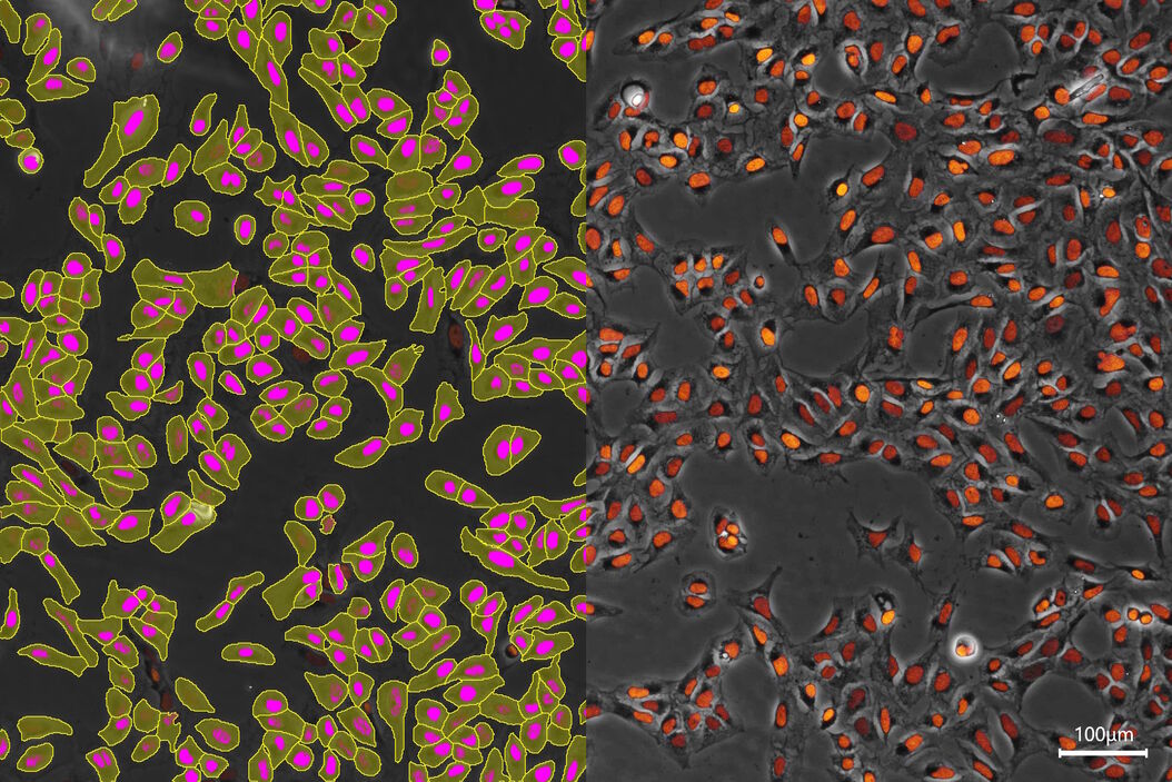 [Translate to chinese:] AI-based transfection analysis (left) of U2OS cells which were transfected with a fluorescently labelled protein. A fluorescence image of the cells (right) is also shown. The analysis and imaging were performed with Mateo FL. AI-based_analysis_of_U2OS_cells_transfected_with_fluorescently_labelled_protein.jpg