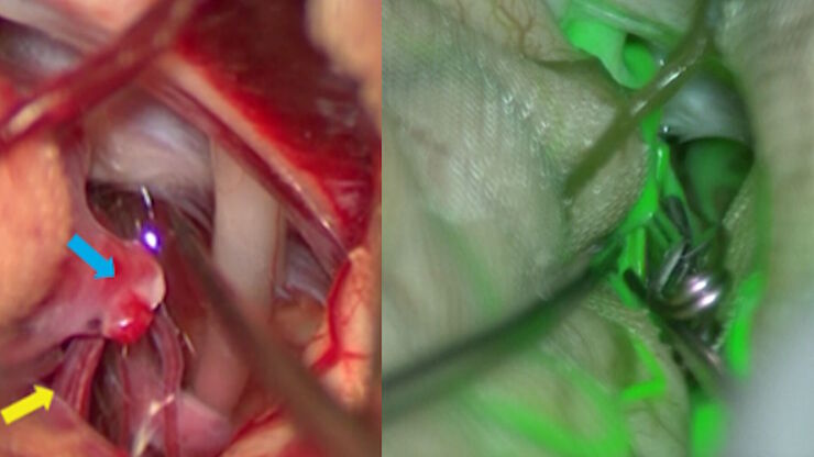 GLOW800 Augmented Reality Fluorescence used for real-time blood flow visualization in aneurysm clipping surgery