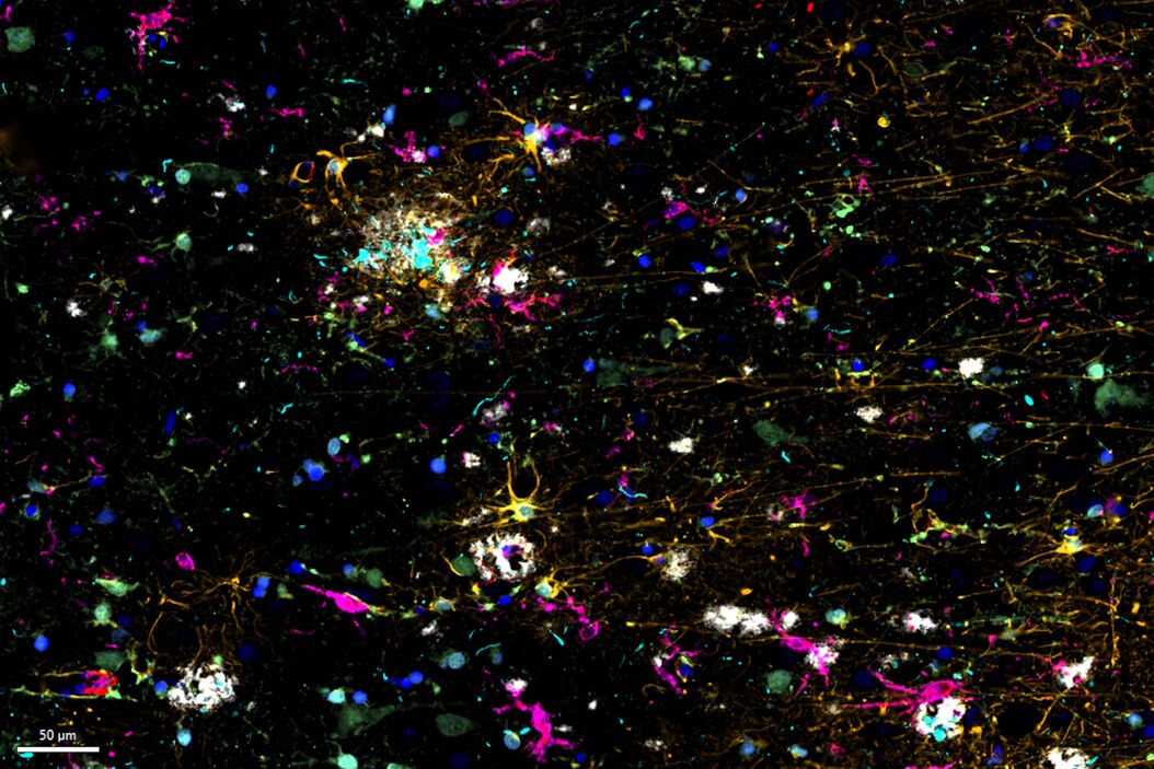 Multiplexed Cell DIVE imaging of Adult Human Alzheimer’s brain tissue section demonstrating expression of markers specific to astrocytes (GFAP, S100B), microglia (TMEM119, IBA1), AD-associated markers (p-Tau217, β-amyloid) and immune cells such as CD11b+, CD163+, CD4+, and HLA-DRA+, clustered around the β-amyloid plaques. Alzheimers_brain_tissue_section_showing_astrocytes_microglia_immune_cells.jpg