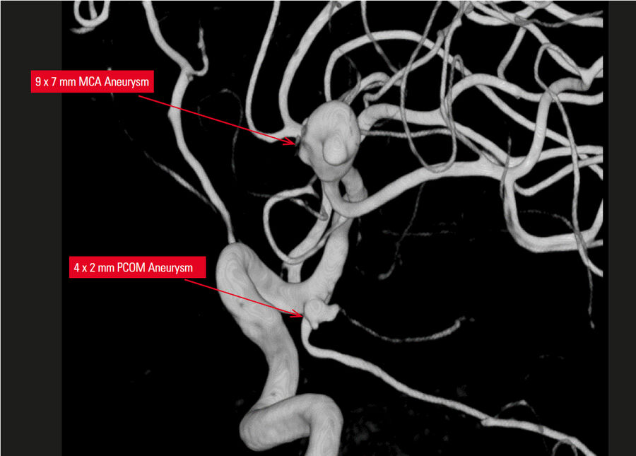 3D重构显示MCA和PCOM动脉瘤。