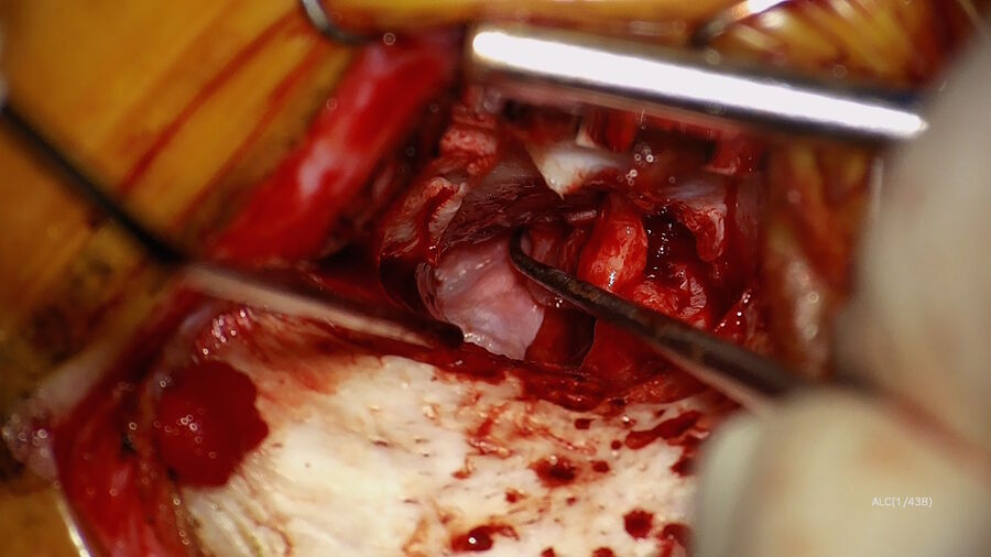 图3：插入颞肌筋膜移植物。图片由肖恩·弗拉纳根博士提供