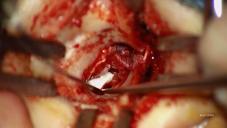 图5：放置复合软骨膜和软骨岛状移植物。图片由肖恩·弗拉纳根博士提供