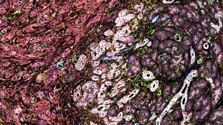 Pancreatic Ductal Adenocarcinoma with 11 Aerobic Glycolysis/Warburg Effect biomarkers shown – BCAT, Glut1, HK2, HTR2B, LDHA, NaKATPase, PCAD, PCK26, PKM2, SMA1, and Vimentin.