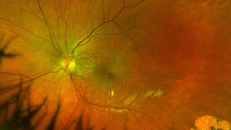 [Translate to chinese:] Fundus photo depicting epiretinal membrane with lamellar macular hole. Image courtesy of Robert A. Sisk, MD, FACS, Cincinnati Eye Institute. 