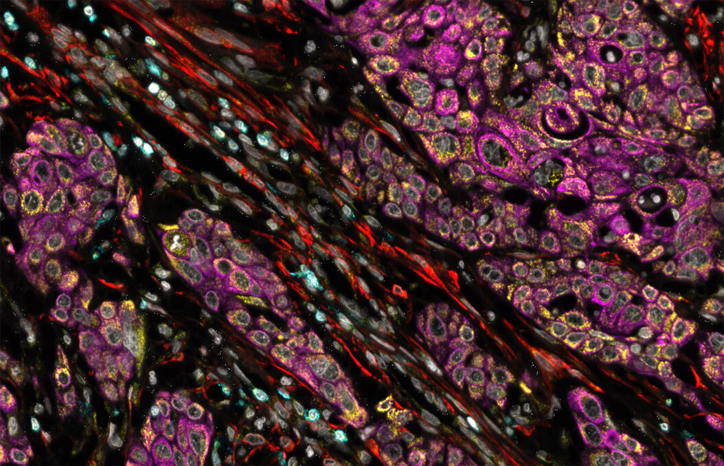 Pncreatic-Ductal-adenocarcinoma_BAK.jpg