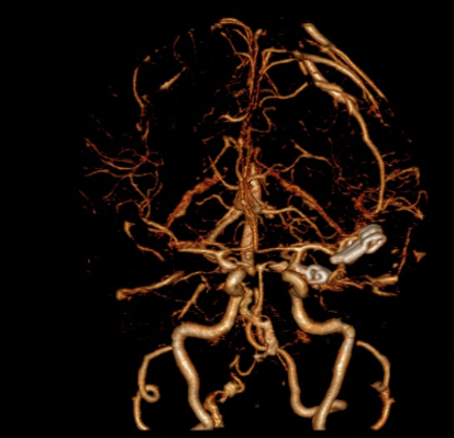 3D重构确认没有血流流入夹闭后的动脉瘤。
